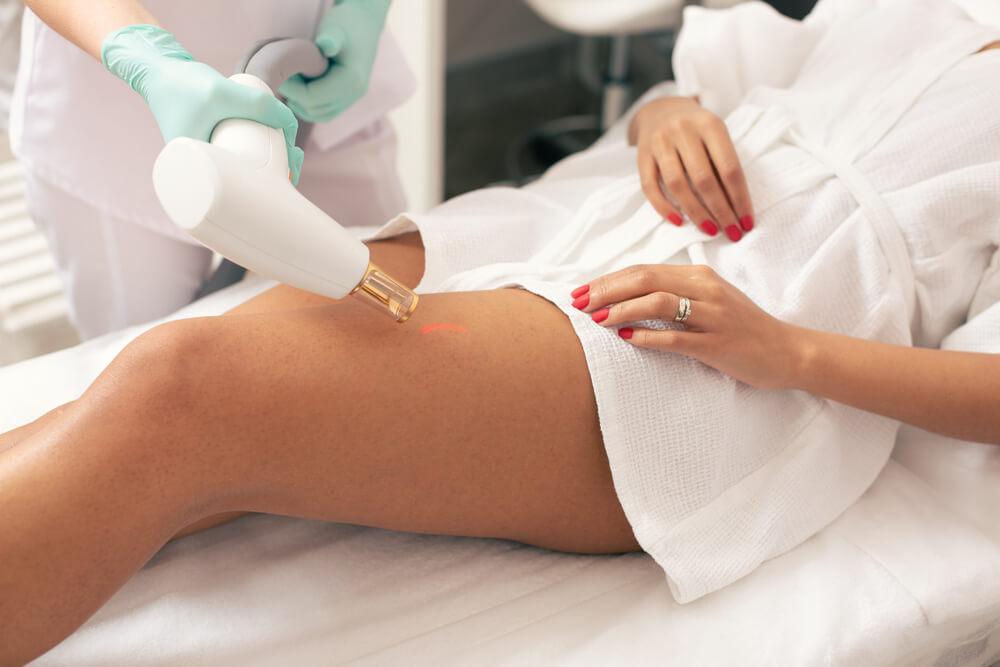 Laser treatment on leg for stretch marks