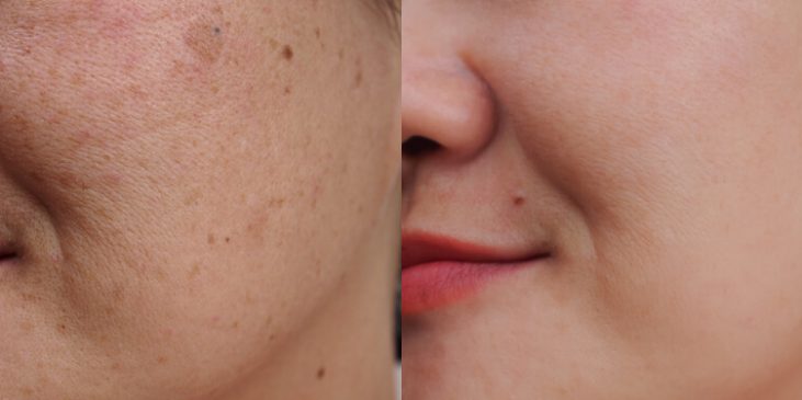 sun damage